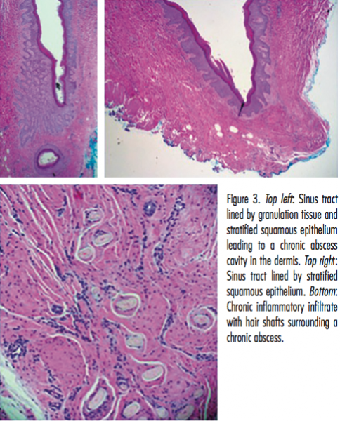 Derm Dx What Is This Supragluteal Cleft Lesion 